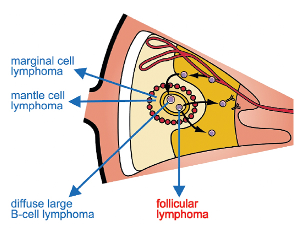 Follicular lymphoma An image showing where follicular lymphoma is located