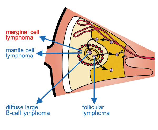 Marginal cell lymphoma An image showing where marginal cell lymphoma is located